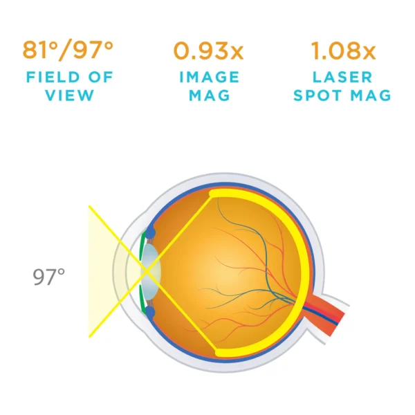 Volk Capsulotomy - Image 2